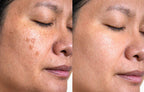 Dark Spot Corrector for Sun Spots & Age Spots | 1+1 FREE