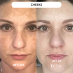 3 x Melasma Corrector