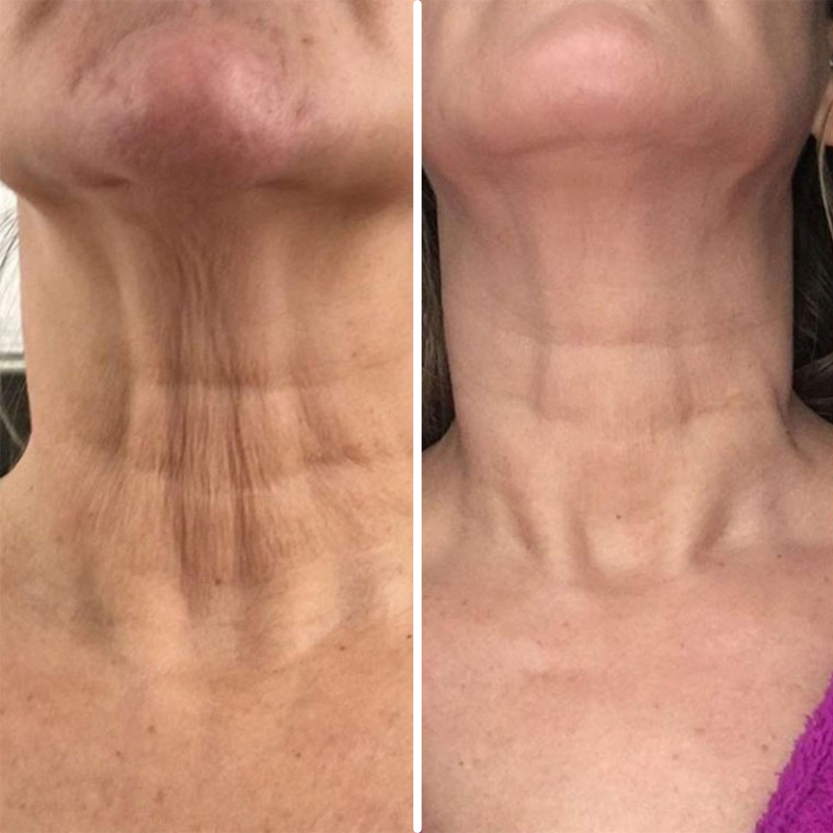 Age-Defying Neck Lift & Firm Cream | 1+1 FREE