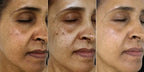 Dark Spot Corrector Serum for Fast Spot Fading & Clear Skin | 1+1 FREE