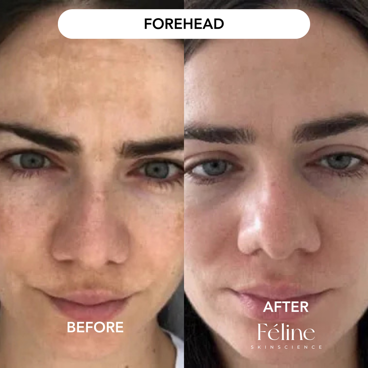 6 x Melasma Corrector