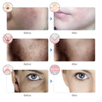 LED Face Mask for Anti Aging, Acne & Skin Rejuvenation