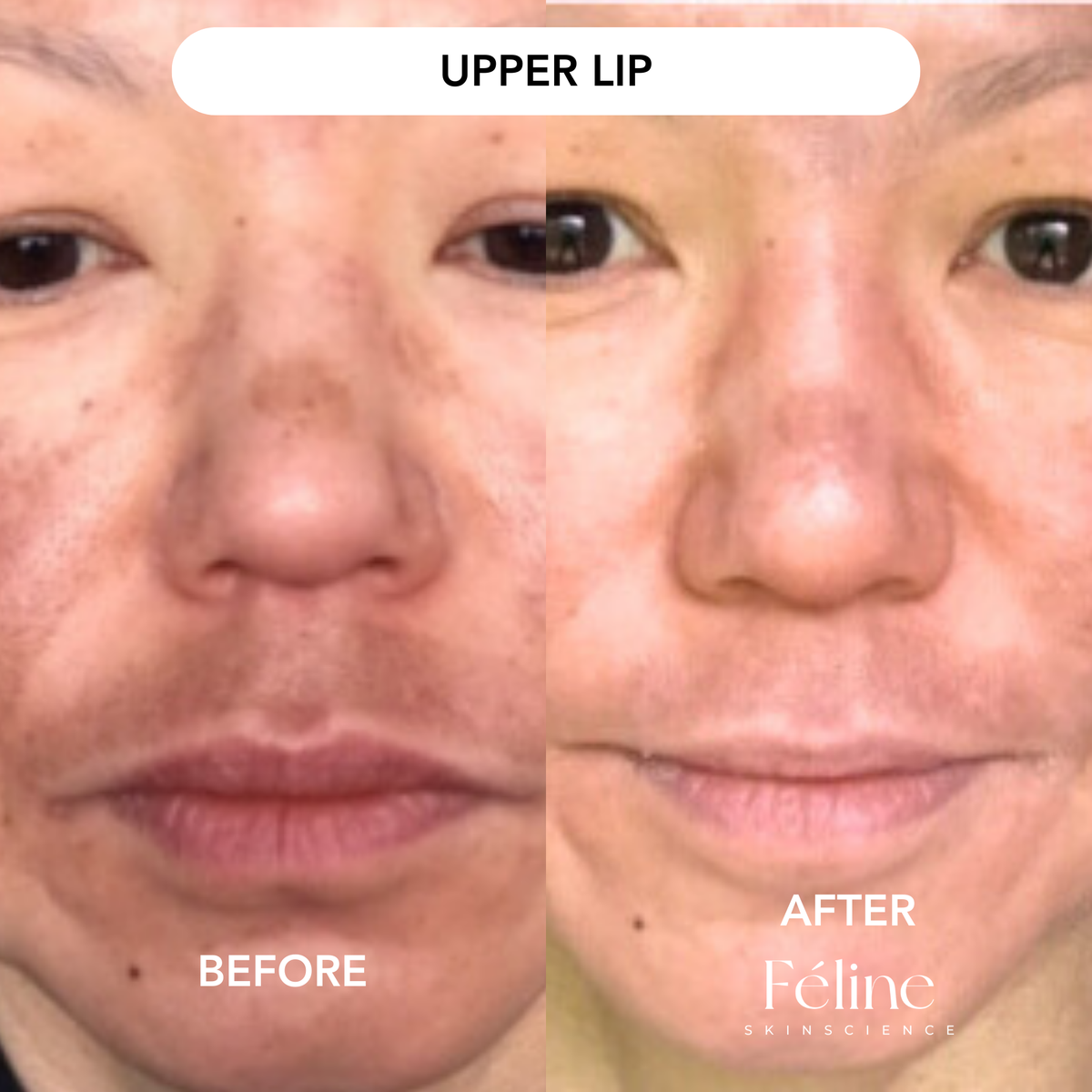 Face Serum for Brown Patches & Uneven Skin Tone | 1+1 FREE