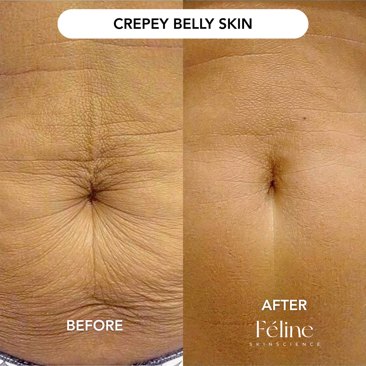 Skin Tightening Cream for Crepey & Loose Skin | 1+1 FREE