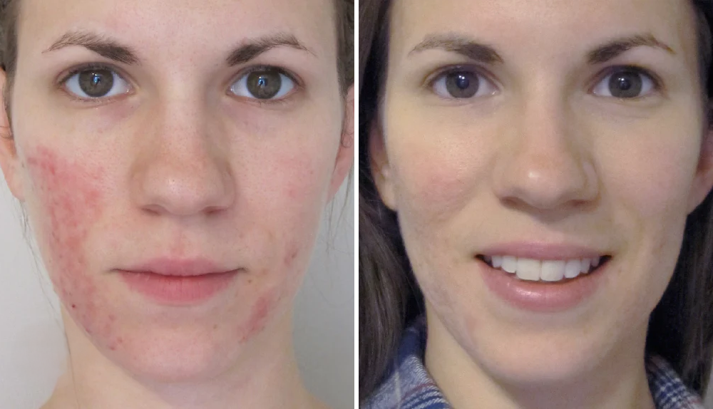 6 x Rosacea Corrector
