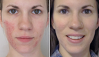 Rosacea Corrector