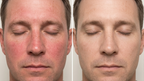 Rosacea Corrector (Men’s Formula) | 1+1 FREE