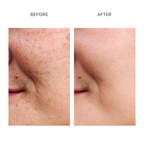 The Complete Dark Spot Solution | Erase & Block
