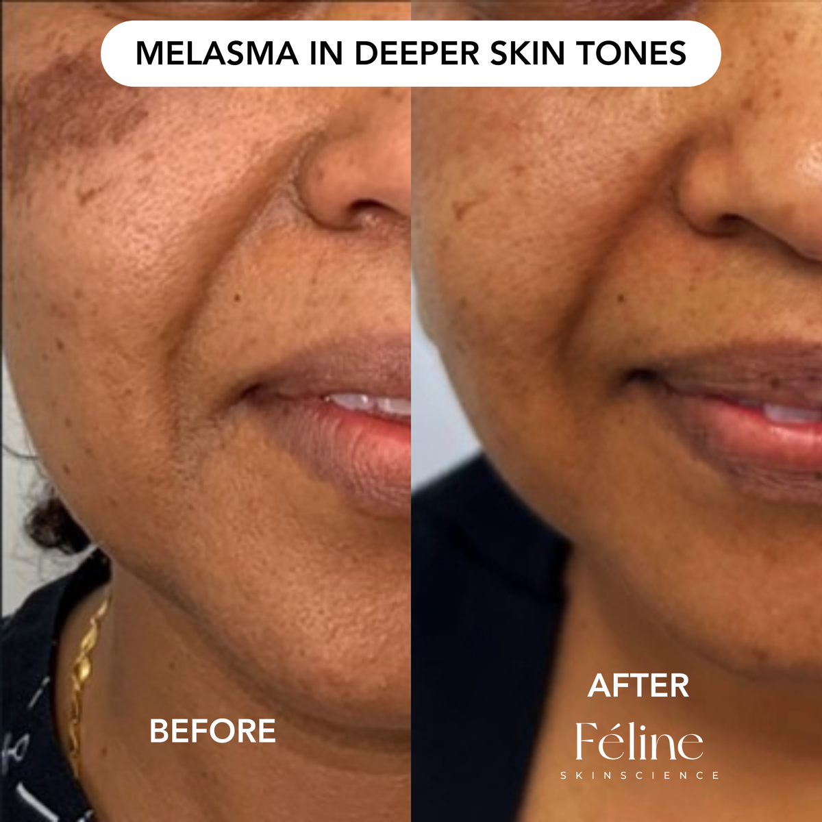 Face Serum for Brown Patches & Uneven Skin Tone | 1+1 FREE