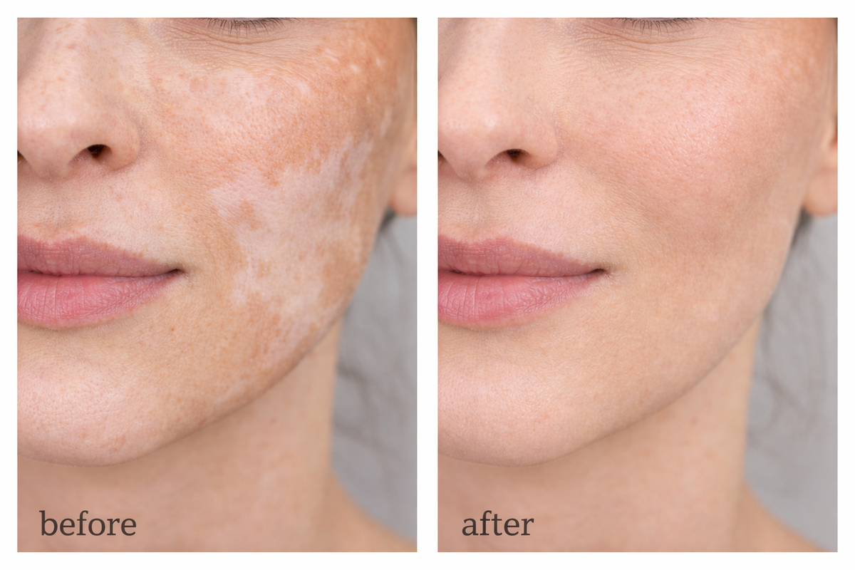 3 x Vitiligo Corrector