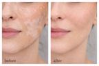 Vitiligo Corrector | 1+1 FREE