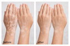 3 x Vitiligo Corrector