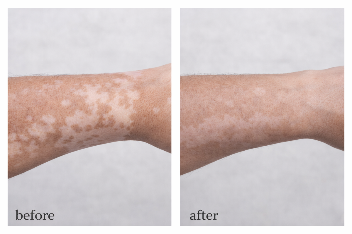 Vitiligo Corrector | 1+1 FREE