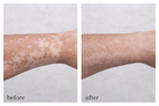 3 x Vitiligo Corrector
