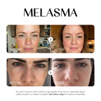 Dark Spot Corrector | 1+1 FREE