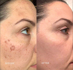 Serum for Hyperpigmentation & Dark Spot Fading | 1+1 FREE
