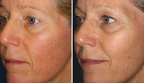Redness Relief Serum for Skin Redness, Pustules & Broken Capillaries | 1+1 FREE