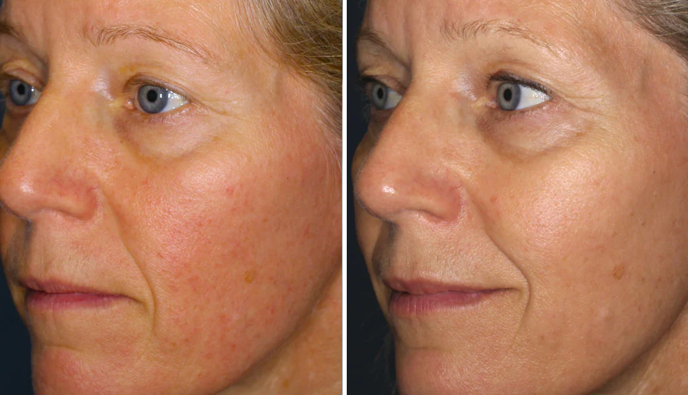 Redness Relief Serum for Skin Redness, Pustules & Broken Capillaries | 1+1 FREE