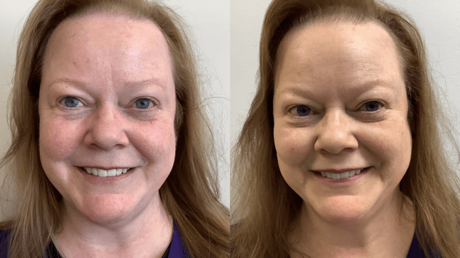 Rosacea Serum Cream for Long-Lasting Redness Control | 1+1 FREE