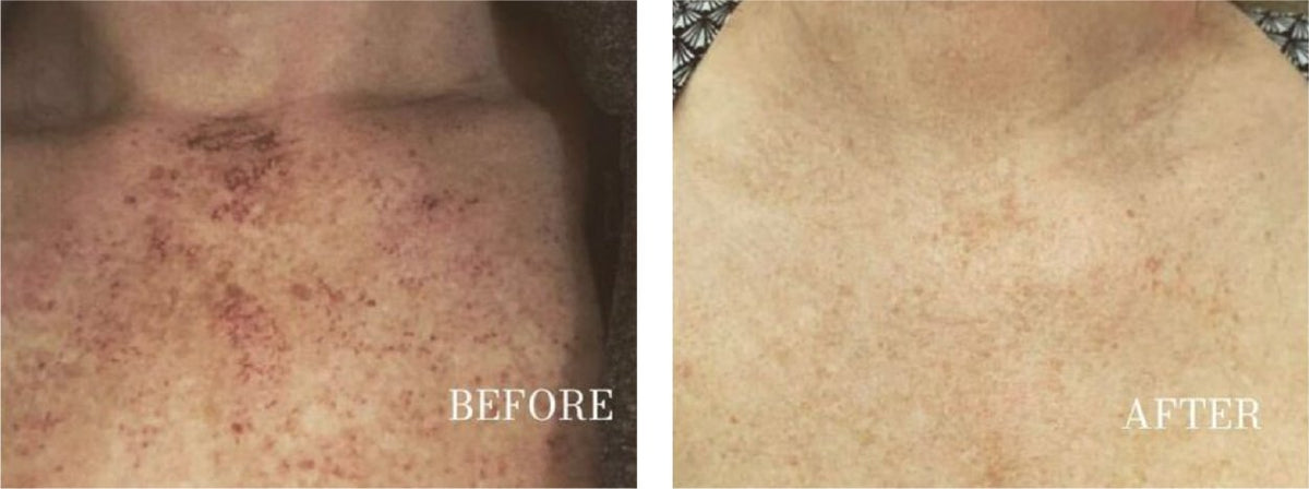 Serum for Hyperpigmentation & Dark Spot Fading | 1+1 FREE