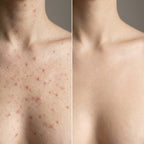 Post Acne Mark Corrector | 1+1 FREE