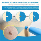 Skin Tag & Mole Remover Pen for Safe Removal at Home
