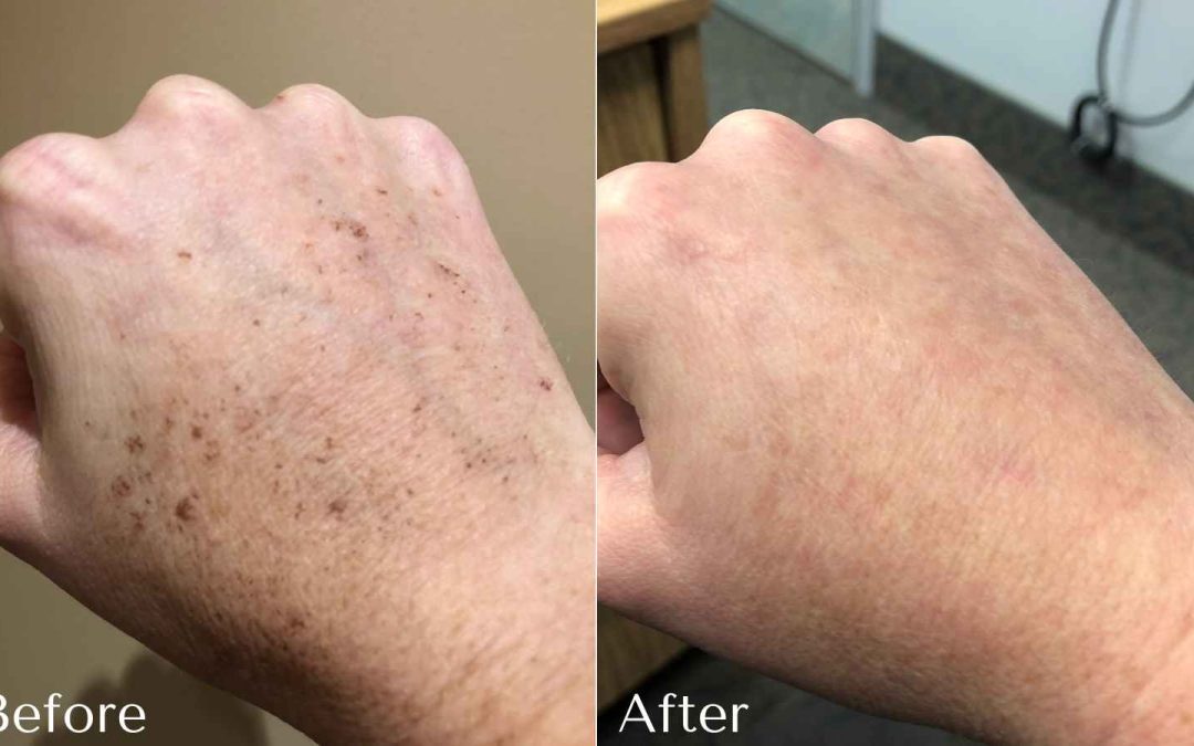 Dark Spot Corrector Serum for Fast Spot Fading & Clear Skin | 1+1 FREE