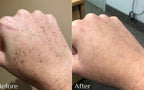 Dark Spot Corrector for Sun Spots & Age Spots | 1+1 FREE