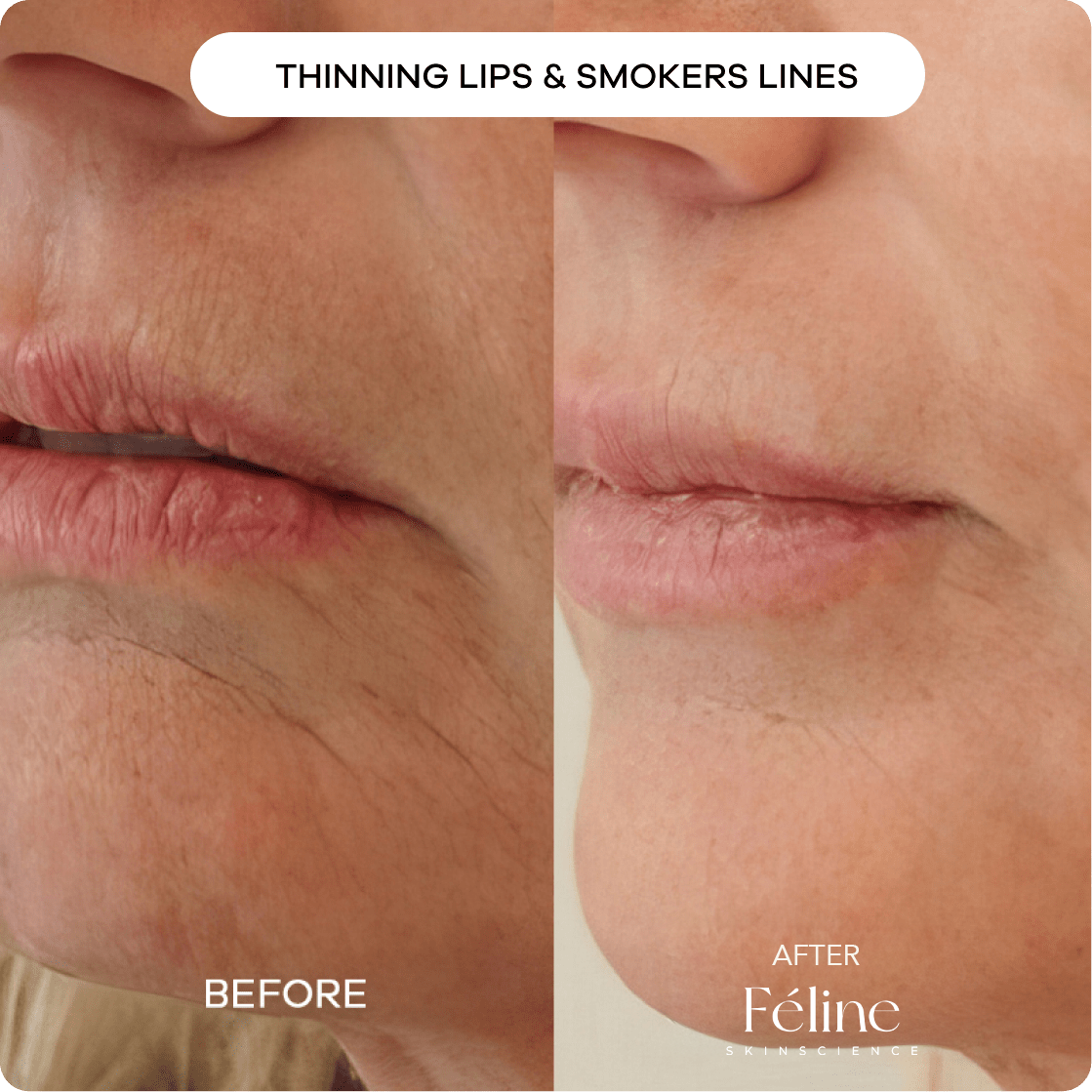 Chest & Décolletage Wrinkle Cream | 1+1 FREE