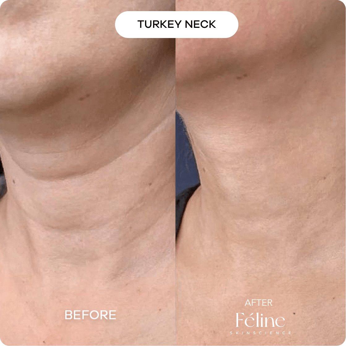 Leg Skin Tightening Cream for Loose Skin | 1+1 FREE